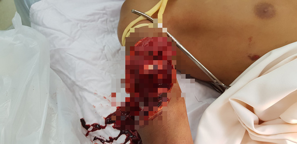 Đi bắt chuột ngoài đồng, nam sinh bị máy gặt cuốn gần đứt cánh tay ảnh 1