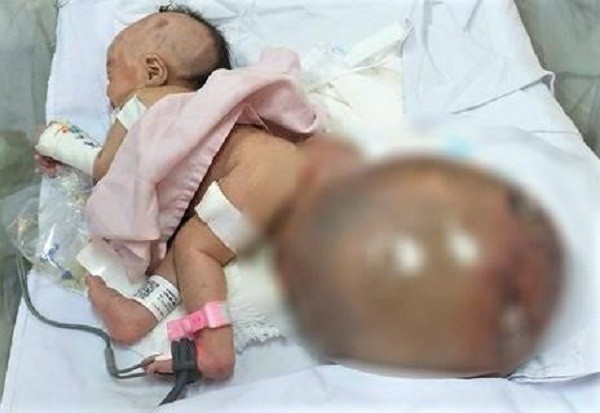 Bé gái chào đời mang khối bướu quái nặng gấp 1,5 lần cơ thể ảnh 1