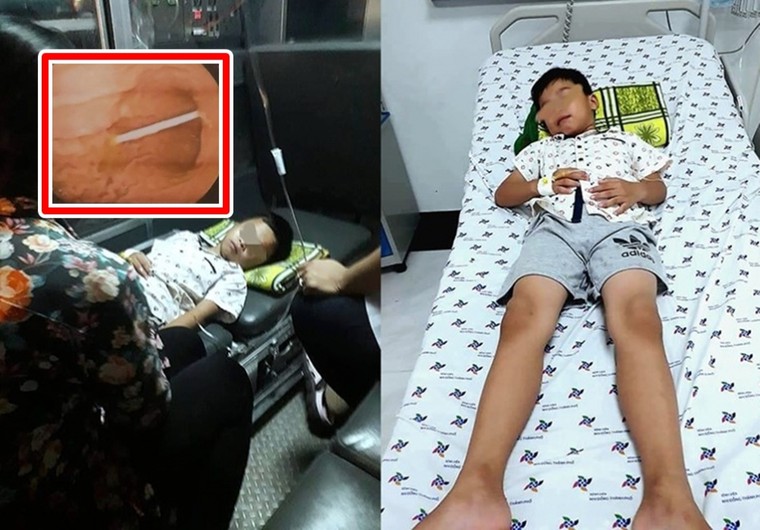 Ngủ quên, bé trai 7 tuổi nuốt cả que nhựa kẹo mút vào họng ảnh 1
