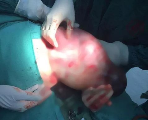 Bé gái hơn 3 kg chào đời còn nguyên trong túi ối ảnh 1