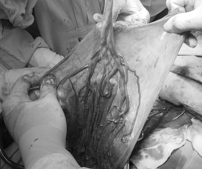 Cứu sống thai nhi bị dây rốn bám màng hiếm gặp ảnh 1