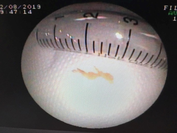 Cứu sống bé gái người Lào bị mắc xương cá trong phế quản cả tháng trời ảnh 1