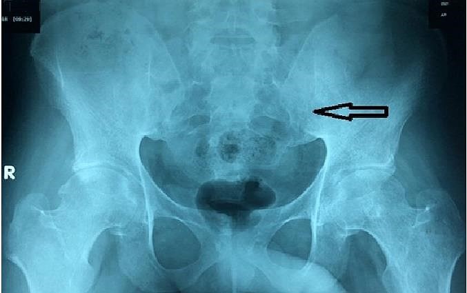 Suýt cứng khớp tay chân do nằm bất động 6 tháng trị cột sống ảnh 1