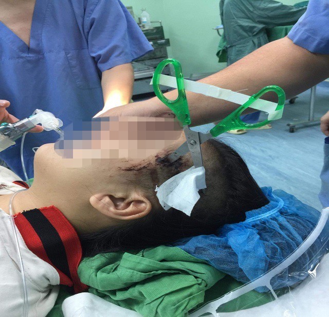 Bị kéo nhọn găm vào đầu 3cm, bé gái nhập viện nguy kịch ảnh 1