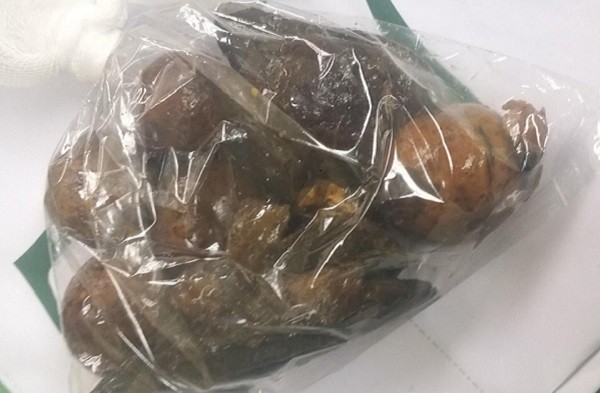 Lấy khối bã thức ăn chứa hạt xoài, quả chanh leo trong dạ dày người đàn ông ảnh 1