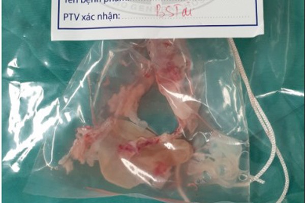 Người đàn ông giảm trí nhớ vì sán làm tổ trong não ảnh 1