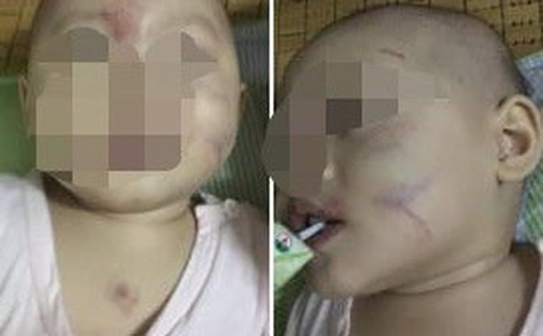 Lộ nguyên nhân bé gái 14 tháng tuổi ở Hải Phòng bầm rập trong ngày đầu đến lớp ảnh 1