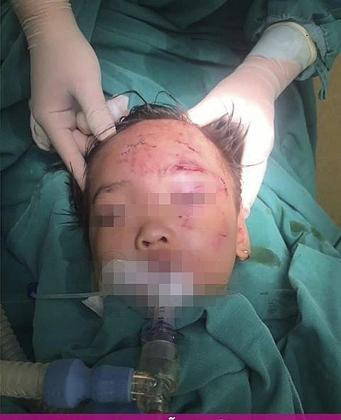 Bé gái 3 tuổi bị chó cắn nát mặt ảnh 1