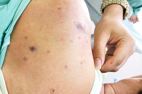 Người đàn ông suy thận vì bị đàn ong vò vẽ tấn công ảnh 1