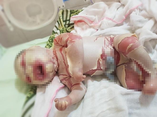 Bé sơ sinh đóng vảy như da cá vì bệnh cực hiếm ảnh 1