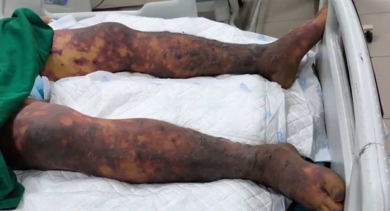 Vi khuẩn liên cầu lợn lây sang người như thế nào? ảnh 1