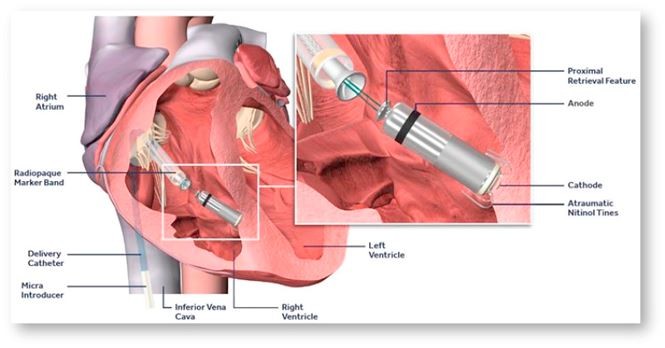 Bệnh viện Chợ Rẫy đặt máy tạo nhịp tim không dây thành công ảnh 5