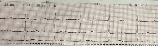 Bệnh viện Chợ Rẫy đặt máy tạo nhịp tim không dây thành công ảnh 1