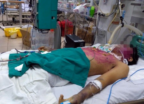 Dùng sai thuốc trị thủy đậu, thanh niên 28 tuổi nguy kịch ảnh 1