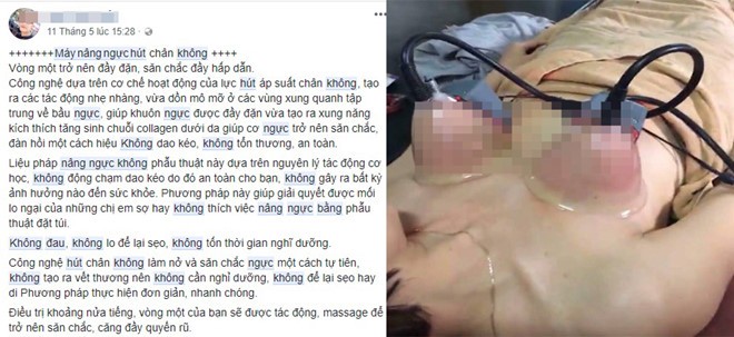 Nâng ngực bằng máy hút chân không: Trò lừa bịp của các cơ sở làm đẹp ảnh 1