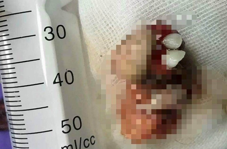 Khối u mọc răng, tóc trong buồng trứng bé gái ảnh 1