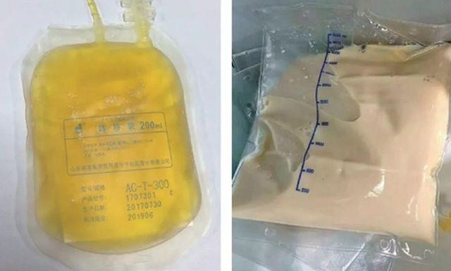 Bác sĩ giật mình khi máu bệnh nhân có lớp váng như mỡ, do ăn những món ai cũng thích ảnh 3