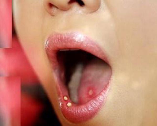 Nhiệt miệng 2 tháng không khỏi, cô gái bị cắt nửa chiếc lưỡi sau khi khám ảnh 1