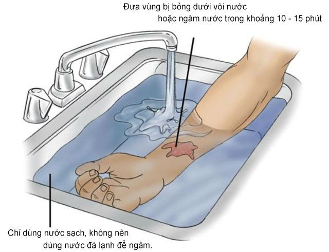 Bé 20 tháng bị bỏng nguy kịch vì vật dụng nhà nào cũng có ảnh 1