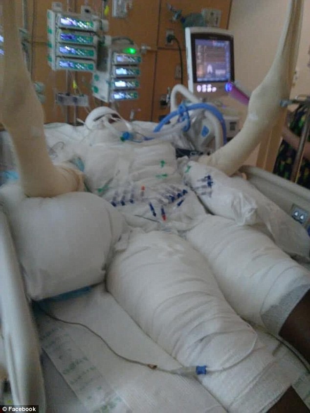 Thiếu nữ bỏng nặng vì học theo trào lưu điên rồ trên mạng xã hội ảnh 1