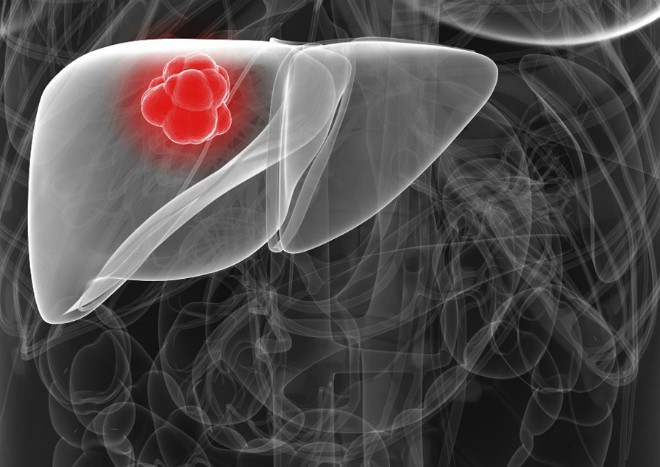 Người Việt bị ung thư gan nhiều nhất thế giới ảnh 2