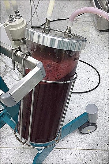 Thai ngoài tử cung vỡ khiến bà bầu nguy kịch ảnh 2