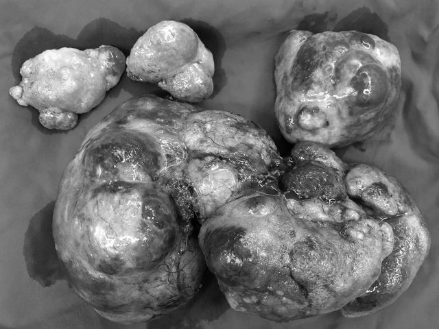 Người phụ nữ Sài Gòn mang khối u hiếm gặp nặng hơn 3 kg ảnh 1