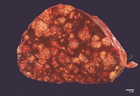 Không phải rượu bia, đây mới là sát thủ gây ung thư gan âm thầm cho người Việt ảnh 1