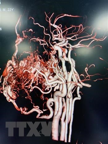 Cần Thơ: Can thiệp thành công ca dị dạng mạch máu má môi ảnh 1