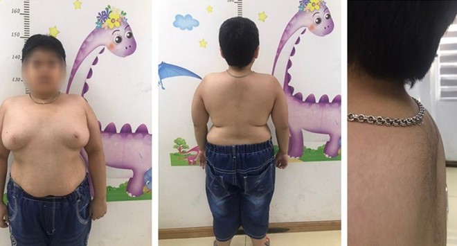 Bé trai rậm lông, ngực nở như con gái vì lạm dụng thuốc corticoid ảnh 1