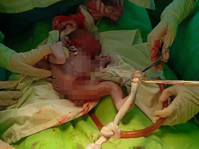 Phẫu thuật cứu sống trẻ sơ sinh bị dây rốn thắt nút ảnh 1