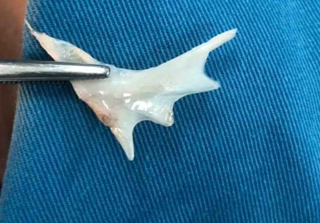 Phẫu thuật gắp thành công xương cá trong thực quản bệnh nhi ảnh 1