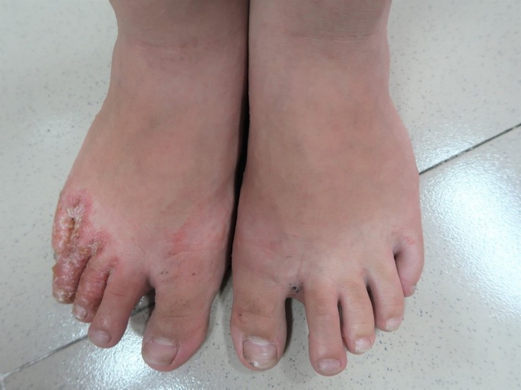 Mùa mưa bão, dân vùng ngập nước thường hay có nguy cơ mắc bệnh da liễu nào? ảnh 1