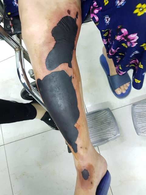 Đắp cao lá vối chữa bỏng, một phụ nữ hoại tử chân, chảy mủ ở vết bỏng ảnh 2