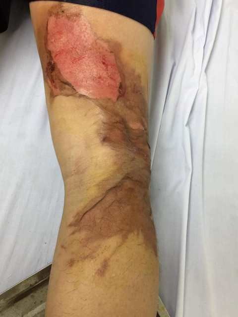 Đắp cao lá vối chữa bỏng, một phụ nữ hoại tử chân, chảy mủ ở vết bỏng ảnh 1