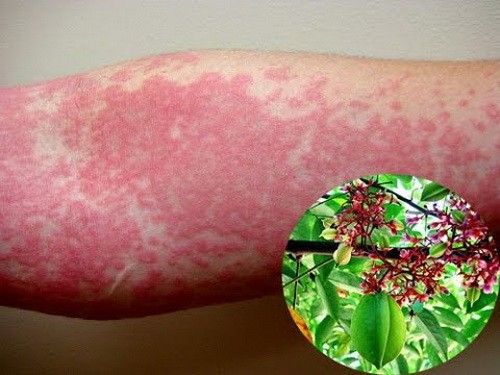 Tiêm chủng chữa dị ứng một tiến bộ mới của y học ảnh 1