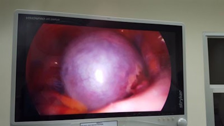 Bé gái 7 tuổi đã bị u nang buồng trứng xoắn hiếm gặp, bác sĩ cảnh báo dấu hiệu bất thường của con cha mẹ không được bỏ qua ảnh 1