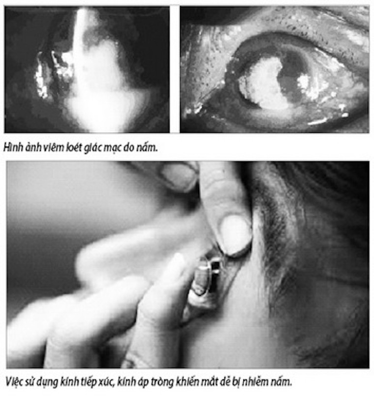 Viêm loét giác mạc do nấm - Chớ coi thường ảnh 1