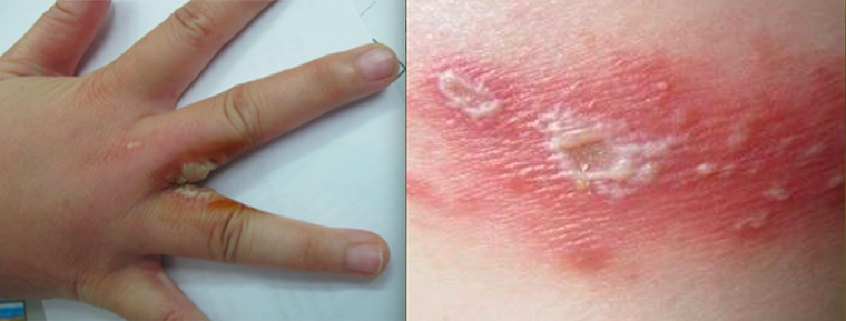 Lời khuyên của bác sĩ khi bị kiến ba khoang đốt ảnh 1