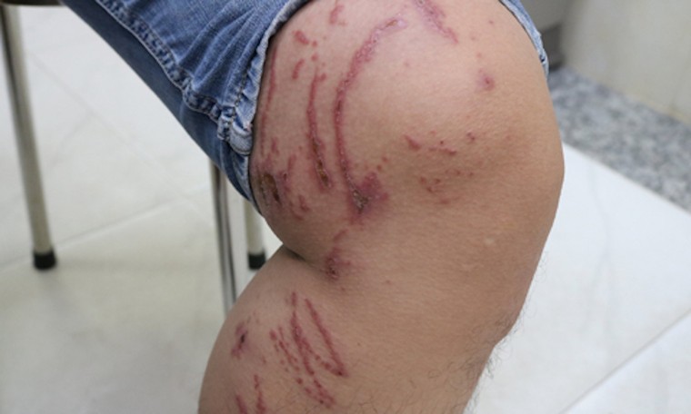 TP.HCM: Cảnh báo nguy cơ bỏng da, viêm da do kiến ba khoang trong mùa mưa ảnh 2