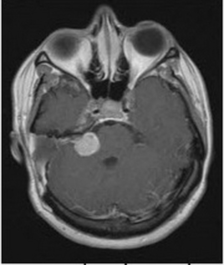 Phát hiện và xử trí sớm điếc đột ngột ảnh 2