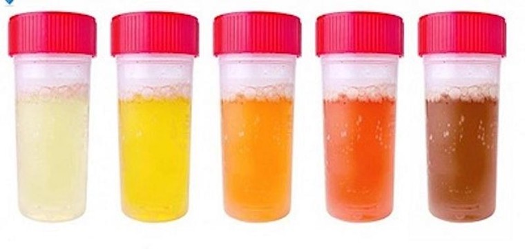 Nhận biết dấu hiệu bệnh tật qua 5 màu nước tiểu ảnh 1