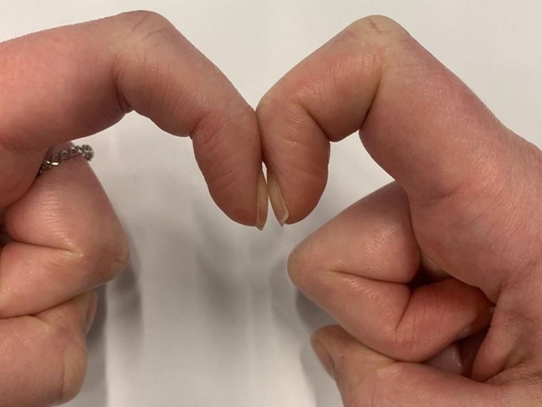 Sự bất thường ở móng tay - Dấu hiệu nhận biết một số bệnh nguy hiểm ảnh 1