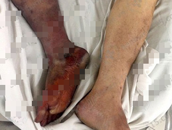 Hoại tử chân do uống thuốc tim mạch không đều ảnh 1
