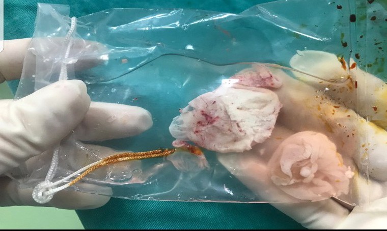 Bị sán làm tổ trong não vì thói quen không ngờ ảnh 1