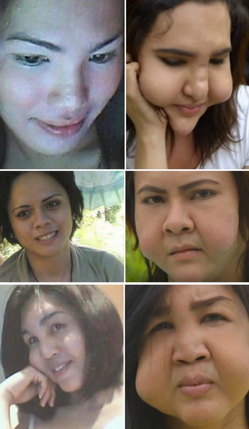 Ba cô gái chuyển giới bị biến dạng mặt vì thẩm mỹ rẻ tiền ảnh 1