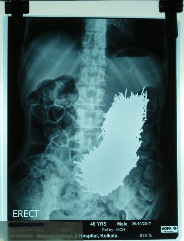 Đau bụng cấp tính vì ăn 600 cái đinh ảnh 1