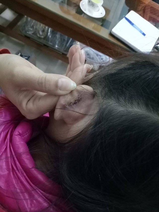 Thanh Hóa: Học sinh lớp 2 bị cô giáo xách đứt tai vì oẳn tù tì trong giờ học ảnh 1