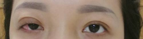 Cô gái vĩnh viễn không thể nhắm mắt sau khi cắt mí làm đẹp ảnh 1