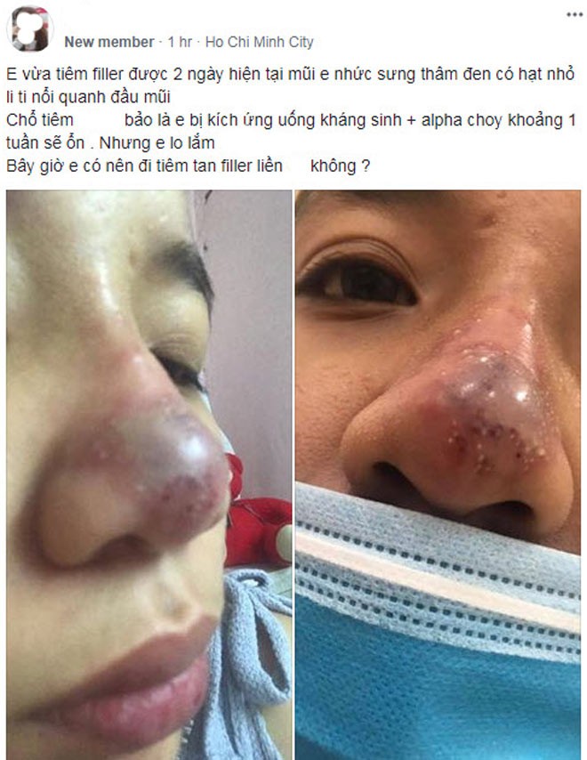 Cô gái Sài Gòn 'bực bội' chia sẻ hình ảnh mũi sưng đen sau tiêm chất làm đầy ảnh 1